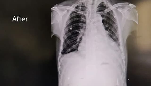 Rare Cardiac Emergency Followed By a Remarkable Outcome image after step 5