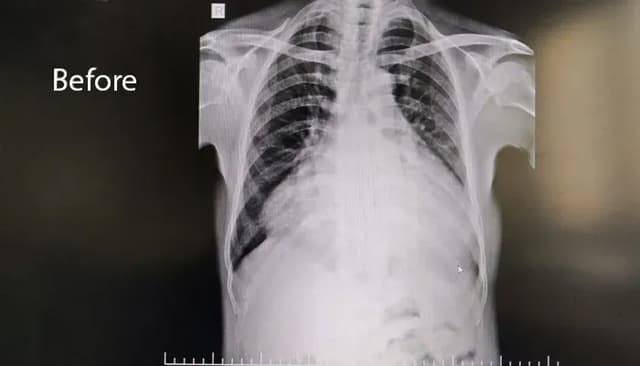 Rare Cardiac Emergency Followed By a Remarkable Outcome image after step 1