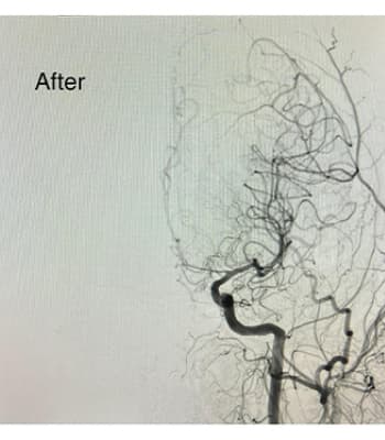 Preventing Stroke Through Timely Intervention image after step 5