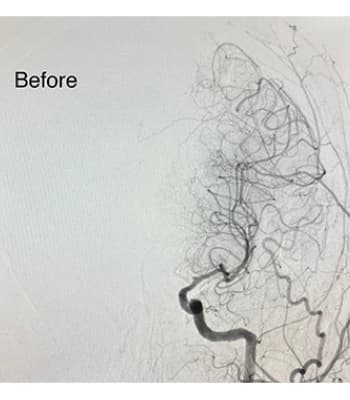 Preventing Stroke Through Timely Intervention image after step 1