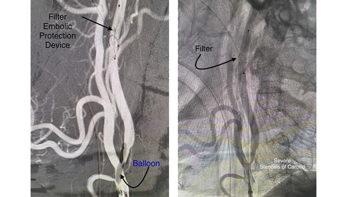 Preventing Stroke Through Timely Intervention diagnostic image